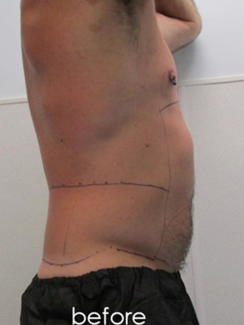 Liposuction Before & After Gallery - Patient 225001 - Image 3