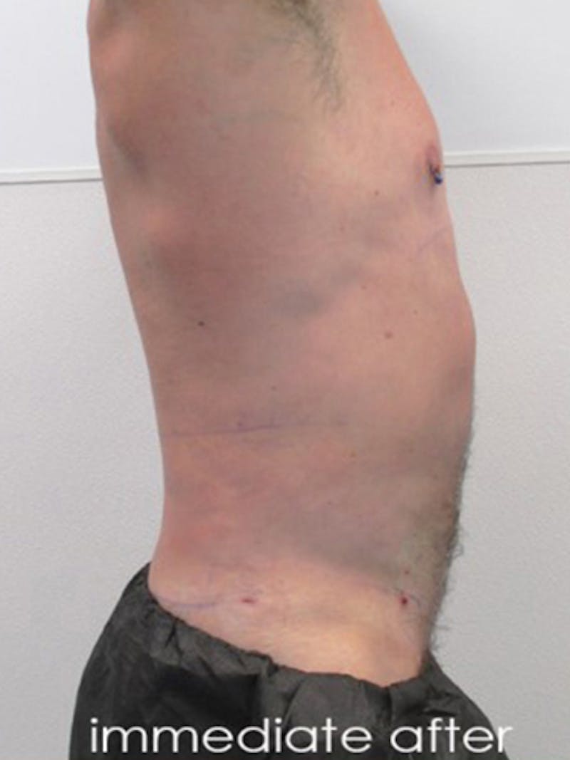 Liposuction Before & After Gallery - Patient 225001 - Image 4