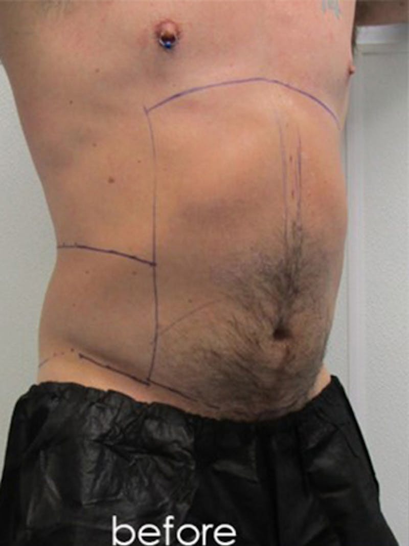 Liposuction Before & After Gallery - Patient 225001 - Image 5
