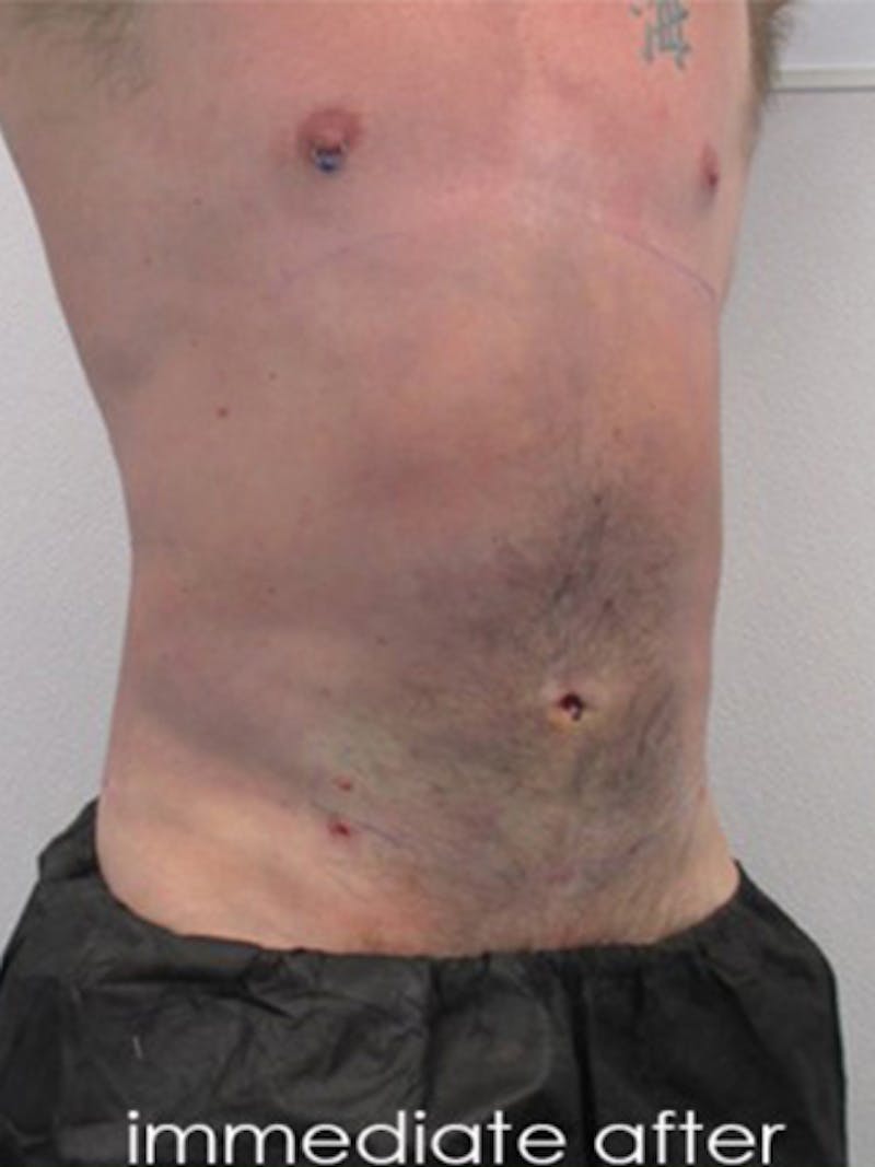 Liposuction Before & After Gallery - Patient 225001 - Image 6