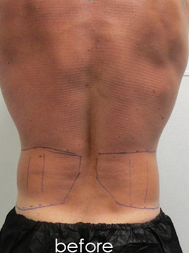 Liposuction Before & After Gallery - Patient 225001 - Image 7