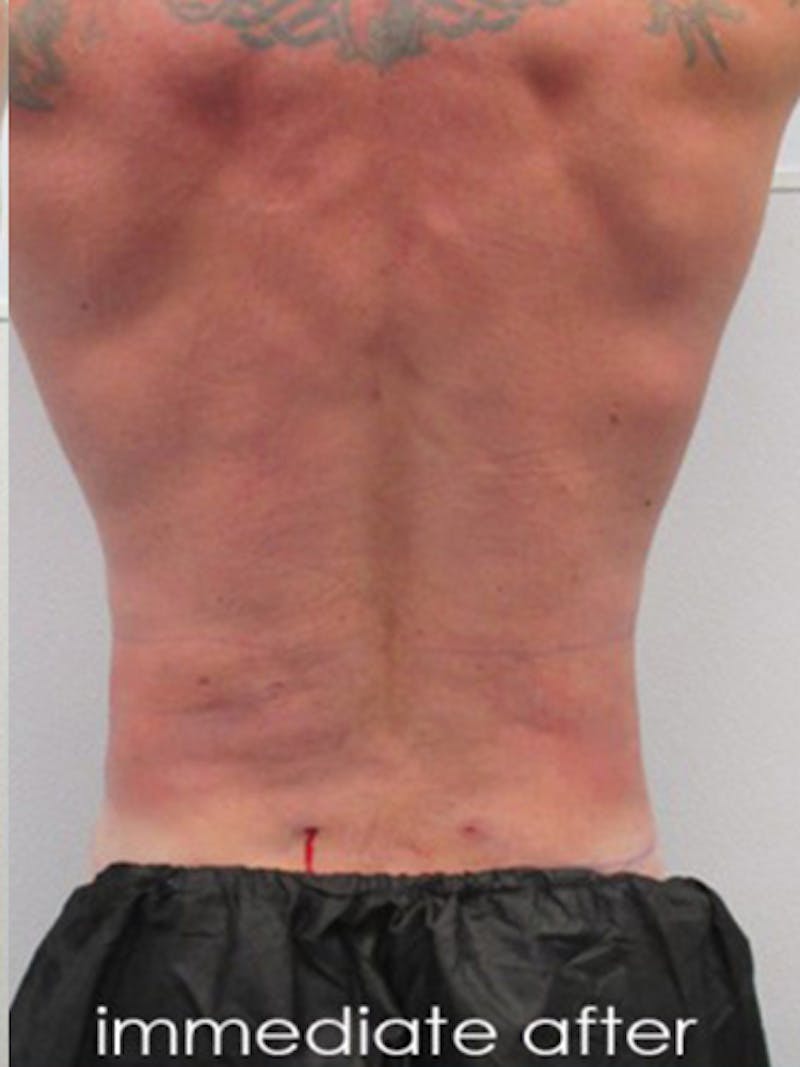 Liposuction Before & After Gallery - Patient 225001 - Image 8