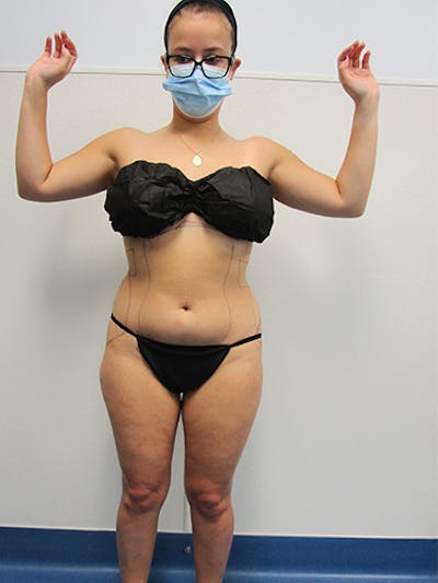 Liposuction Before & After Gallery - Patient 133883 - Image 1