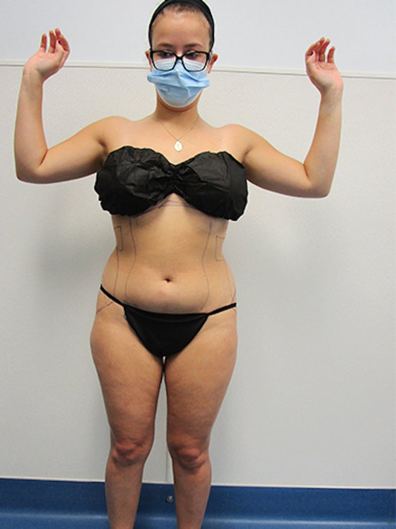 Liposuction Before & After Gallery - Patient 133883 - Image 1