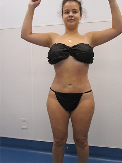 Liposuction Before & After Gallery - Patient 133883 - Image 2
