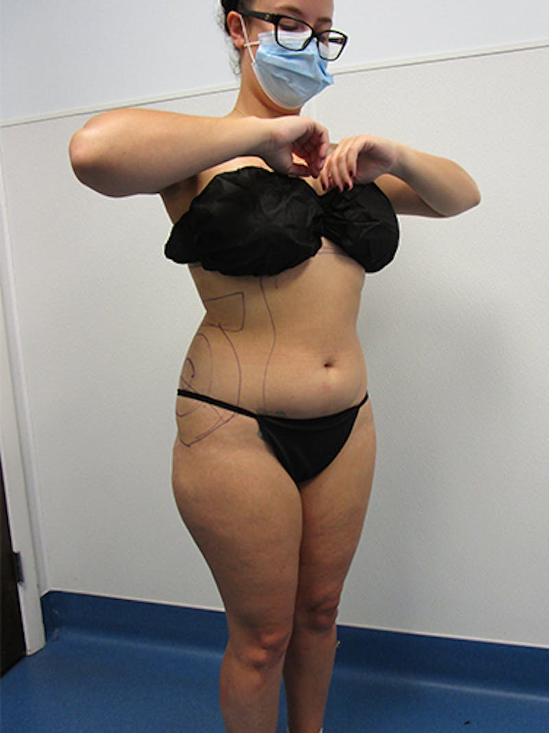 Liposuction Before & After Gallery - Patient 133883 - Image 3