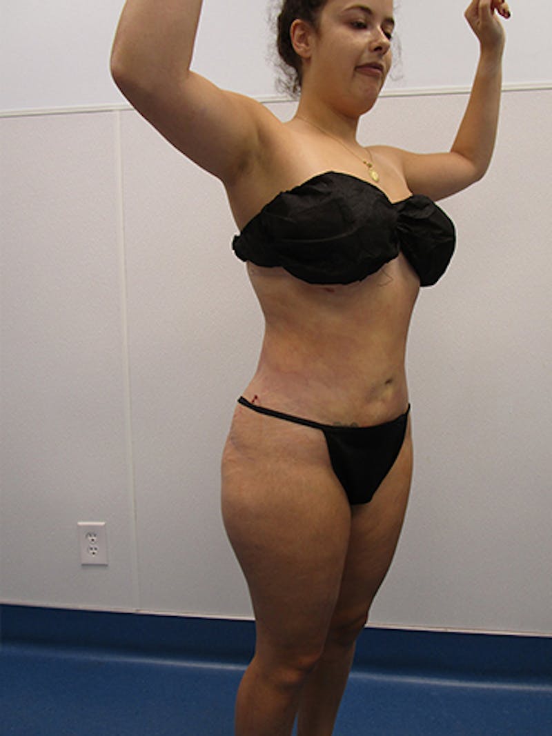 Liposuction Before & After Gallery - Patient 133883 - Image 4