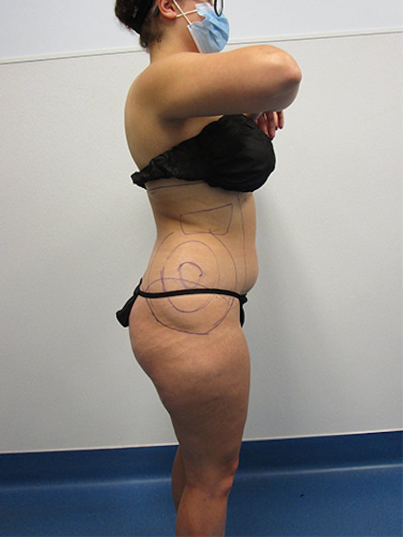 Liposuction Before & After Gallery - Patient 133883 - Image 5