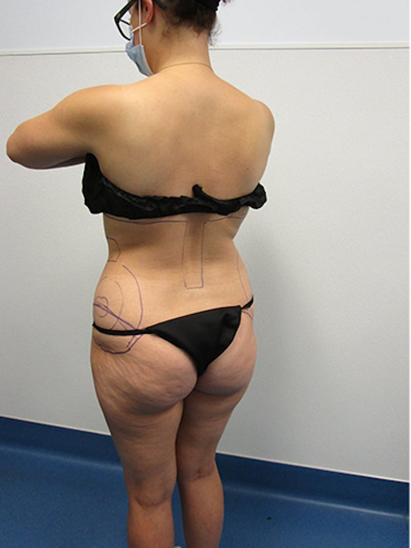 Liposuction Before & After Gallery - Patient 133883 - Image 7