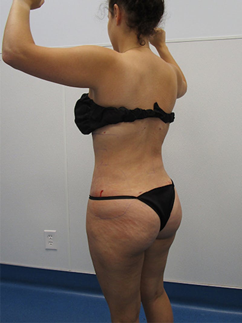 Liposuction Before & After Gallery - Patient 133883 - Image 8