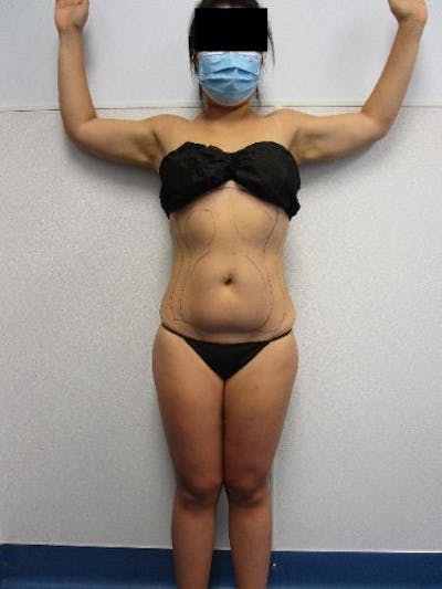 Liposuction Before & After Gallery - Patient 752614 - Image 1