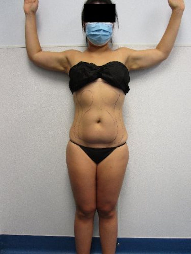 Liposuction Before & After Gallery - Patient 752614 - Image 1