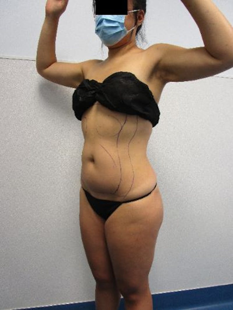 Liposuction Before & After Gallery - Patient 752614 - Image 3