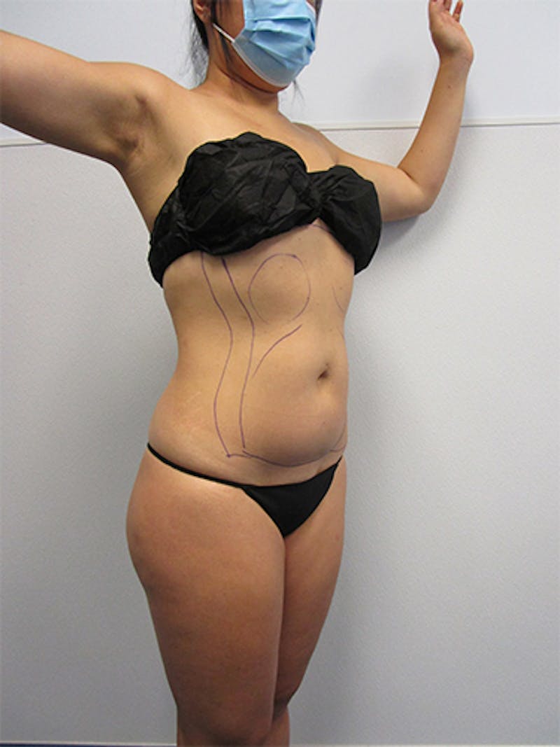 Liposuction Before & After Gallery - Patient 752614 - Image 5