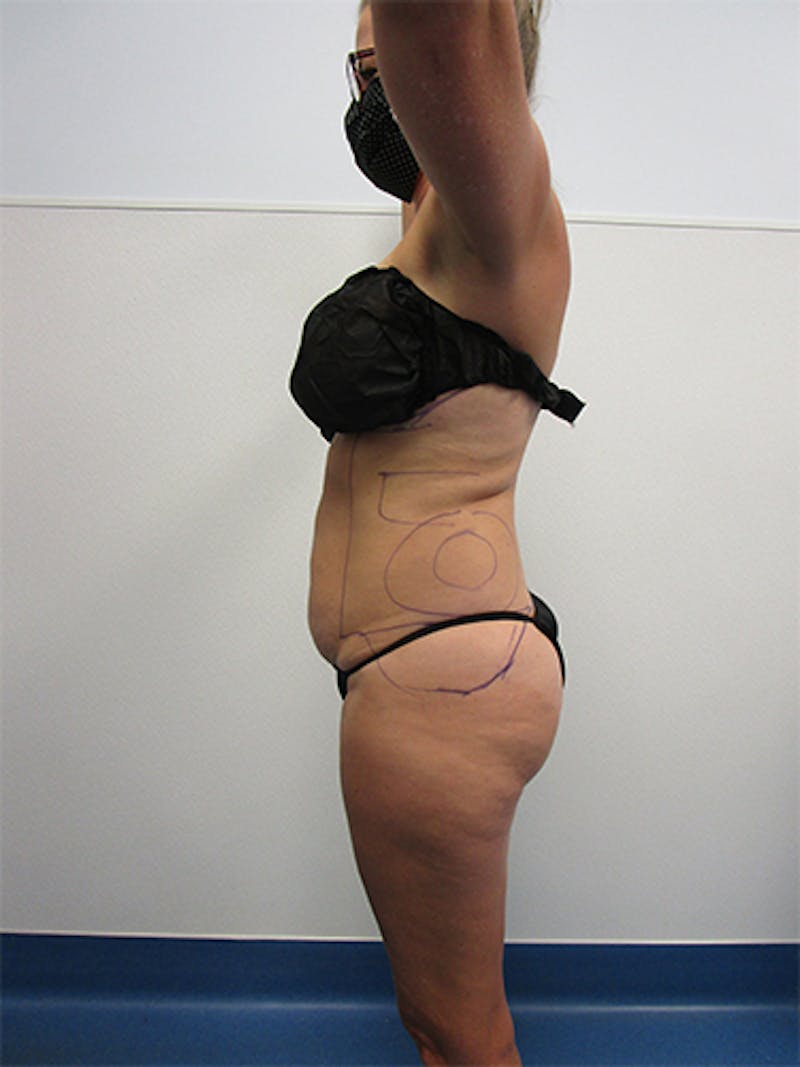 Liposuction Before & After Gallery - Patient 263872 - Image 1