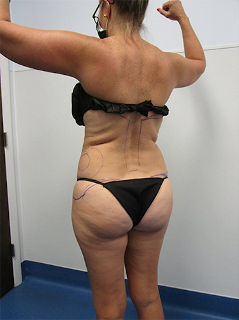 Liposuction Before & After Gallery - Patient 263872 - Image 3