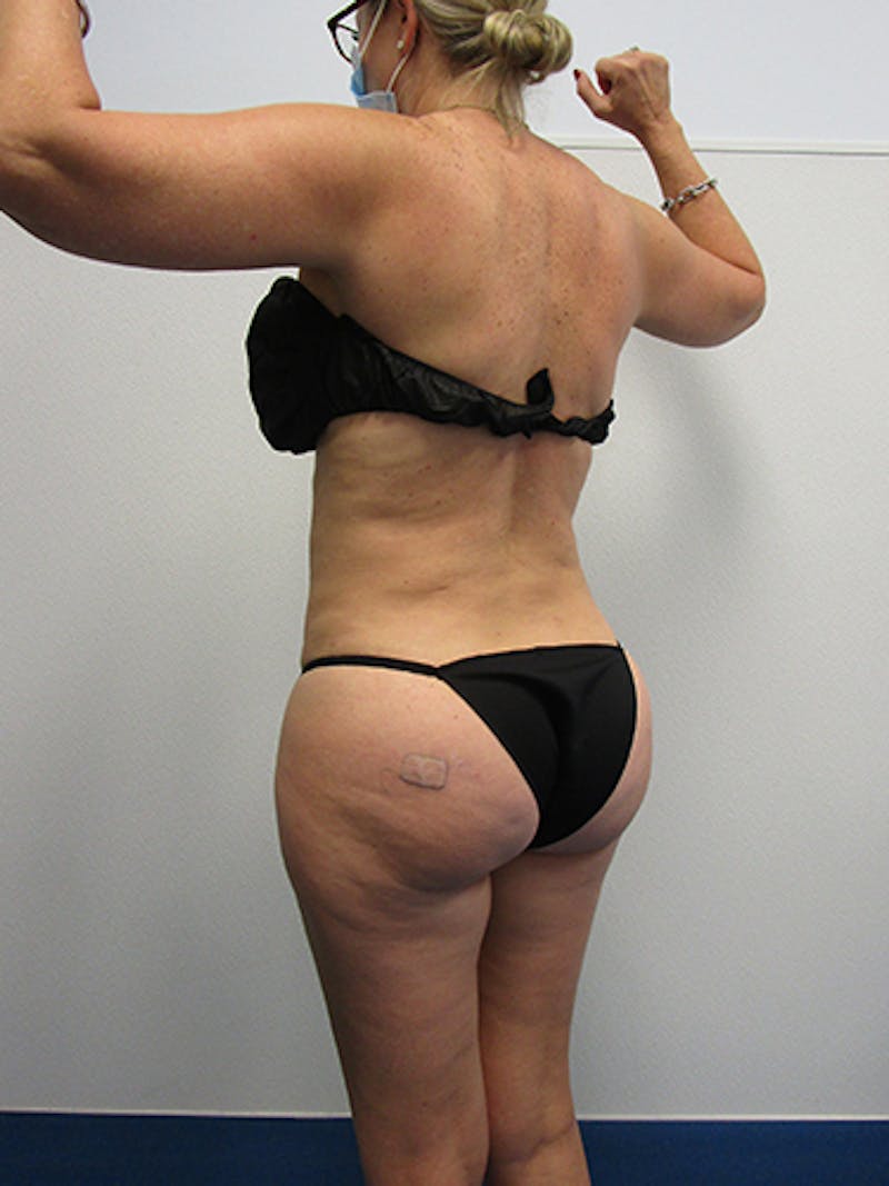 Liposuction Before & After Gallery - Patient 263872 - Image 4
