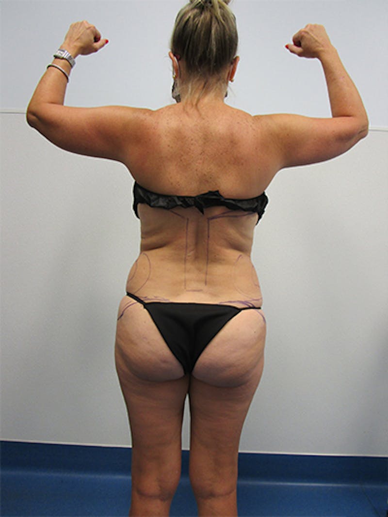 Liposuction Before & After Gallery - Patient 263872 - Image 5