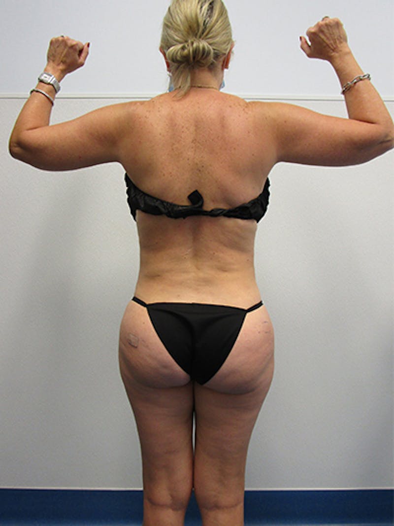 Liposuction Before & After Gallery - Patient 263872 - Image 6