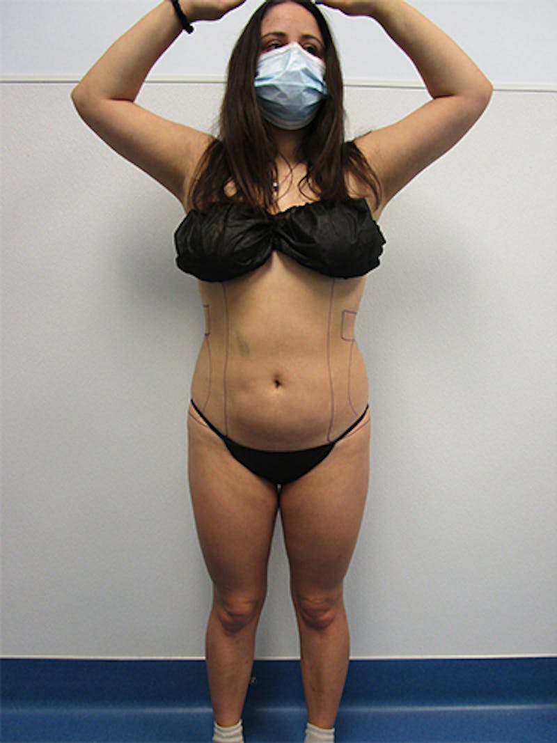 Liposuction Before & After Gallery - Patient 301129 - Image 1