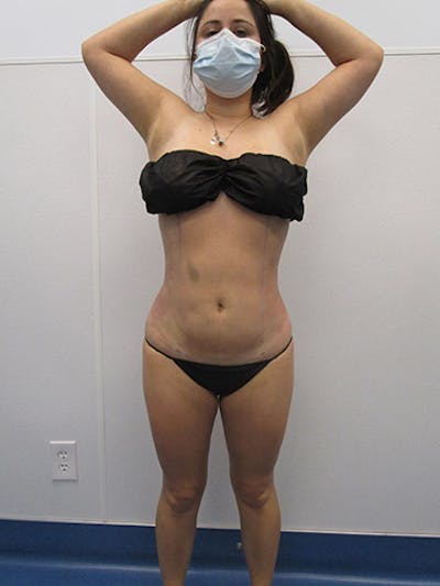 Liposuction Before & After Gallery - Patient 301129 - Image 2