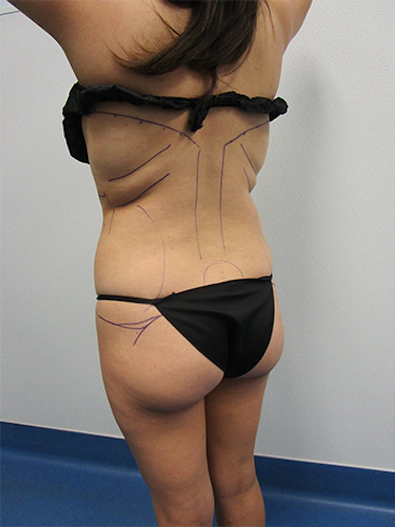 Liposuction Before & After Gallery - Patient 301129 - Image 3