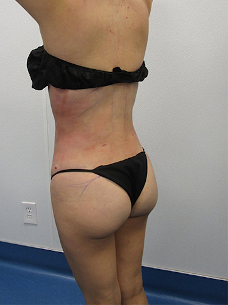 Liposuction Before & After Gallery - Patient 301129 - Image 4