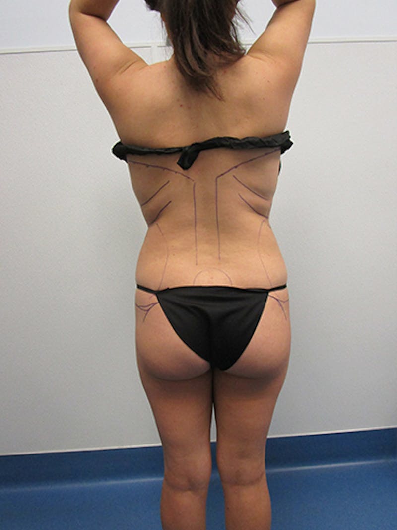Liposuction Before & After Gallery - Patient 301129 - Image 5