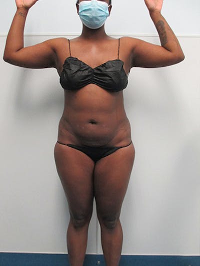 Liposuction Before & After Gallery - Patient 339414 - Image 1