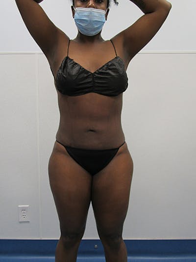 Liposuction Before & After Gallery - Patient 339414 - Image 2