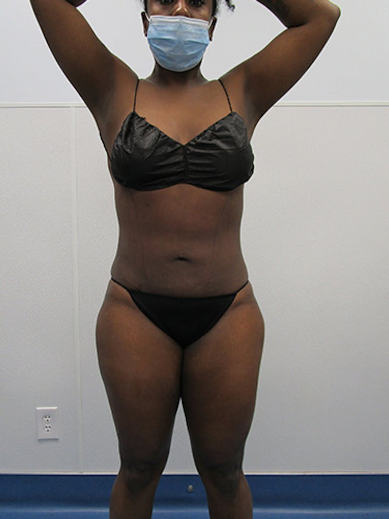 Liposuction Before & After Gallery - Patient 339414 - Image 2
