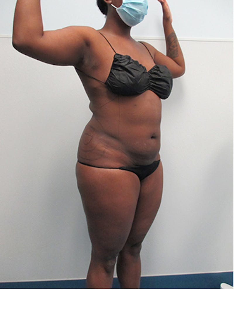 Liposuction Before & After Gallery - Patient 339414 - Image 3