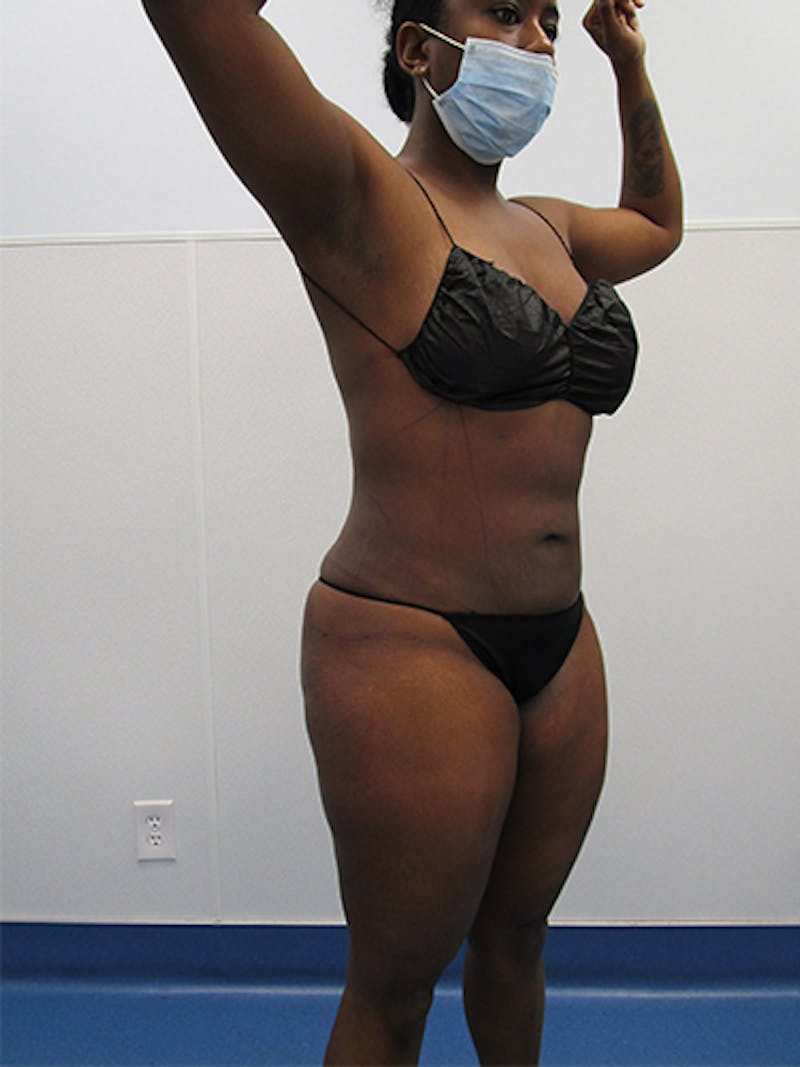 Liposuction Before & After Gallery - Patient 339414 - Image 4