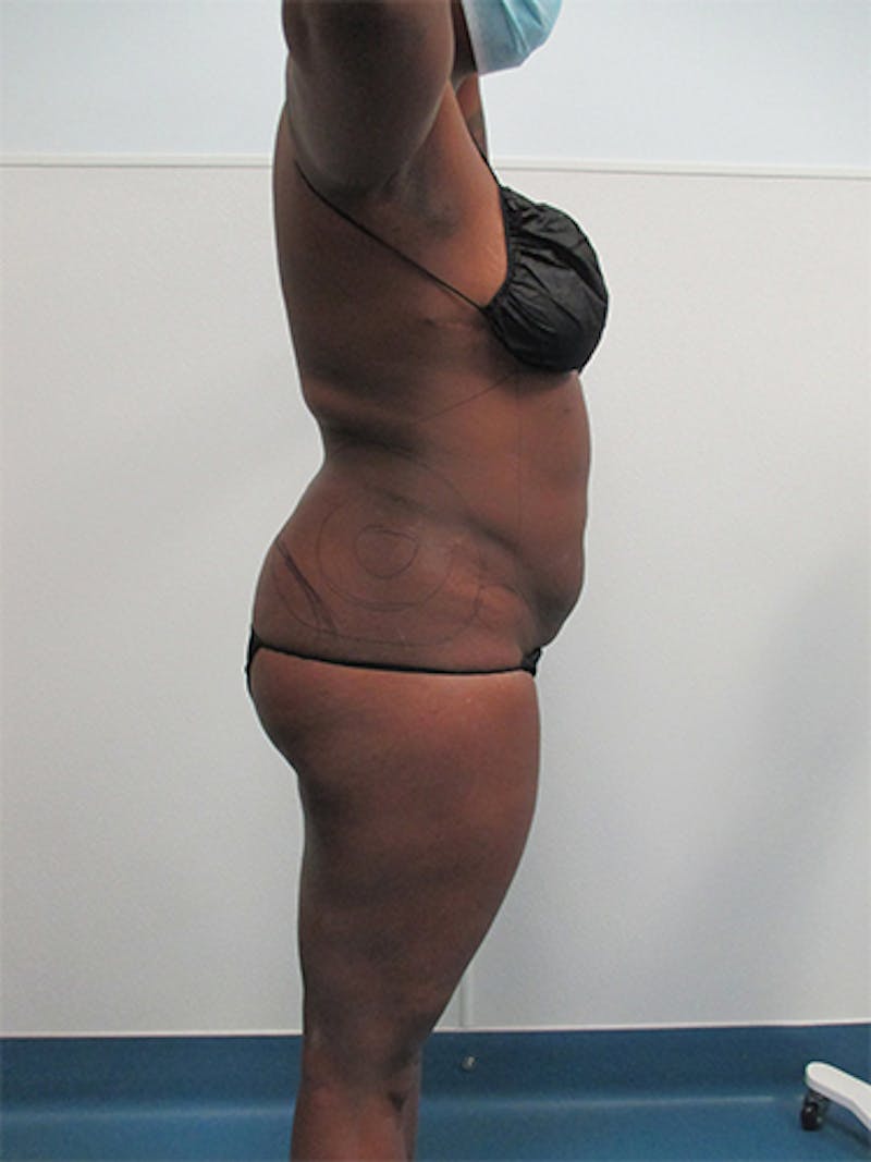 Liposuction Before & After Gallery - Patient 339414 - Image 7