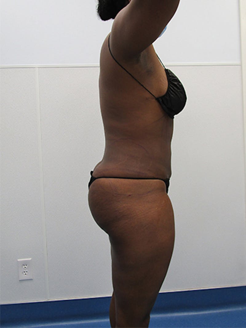 Liposuction Before & After Gallery - Patient 339414 - Image 8
