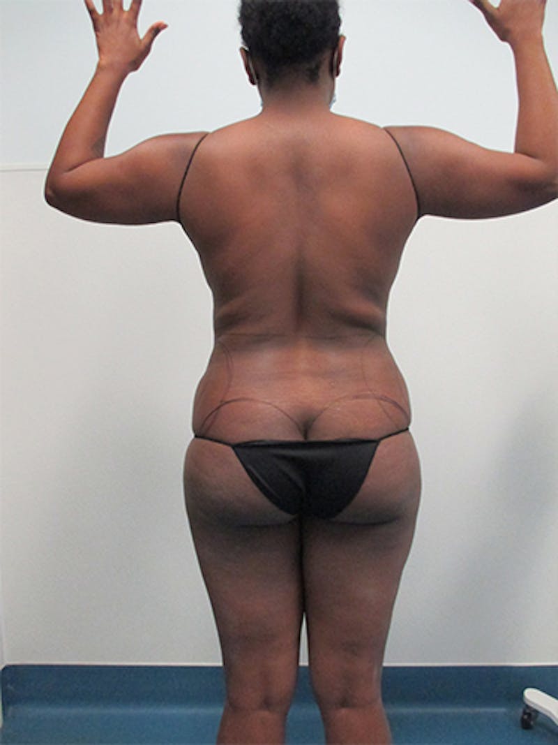 Liposuction Before & After Gallery - Patient 339414 - Image 9