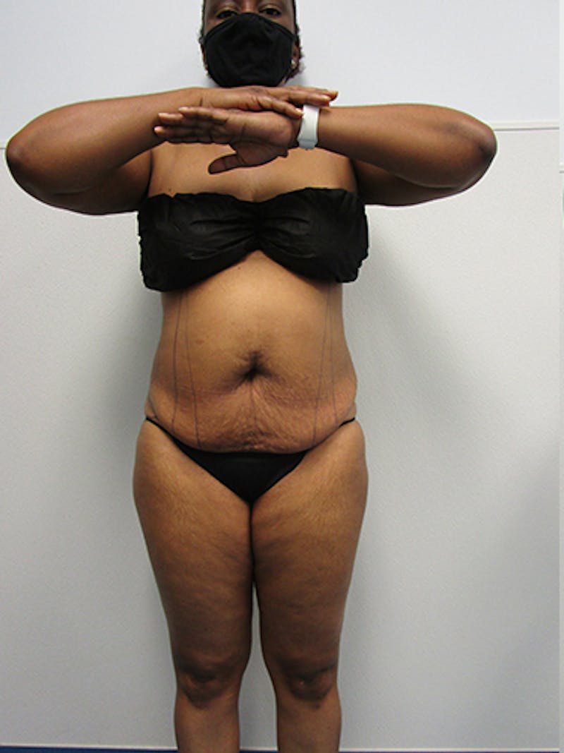 Liposuction Before & After Gallery - Patient 357076 - Image 1