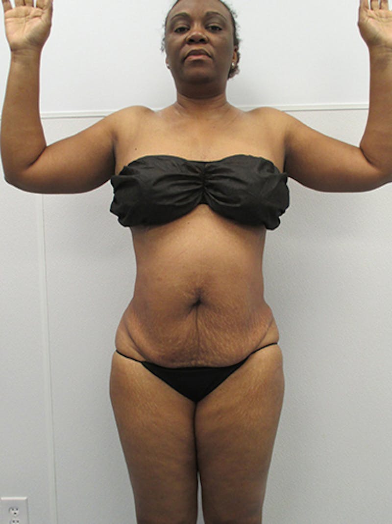 Liposuction Before & After Gallery - Patient 357076 - Image 2