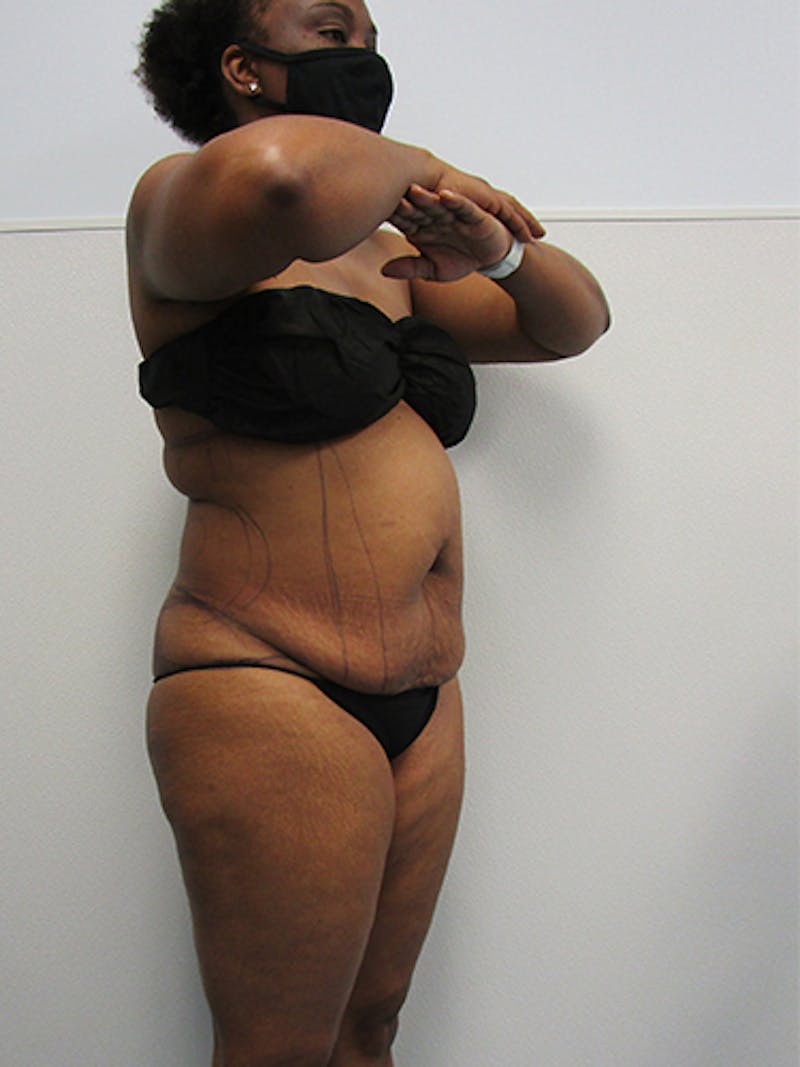 Liposuction Before & After Gallery - Patient 357076 - Image 3