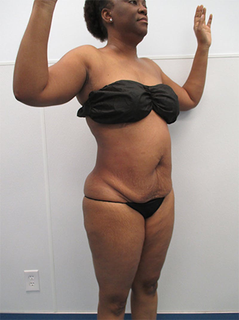 Liposuction Before & After Gallery - Patient 357076 - Image 4