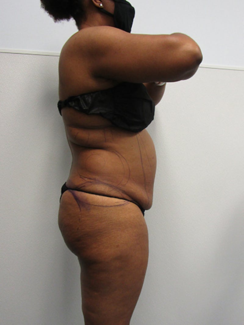 Liposuction Before & After Gallery - Patient 357076 - Image 5