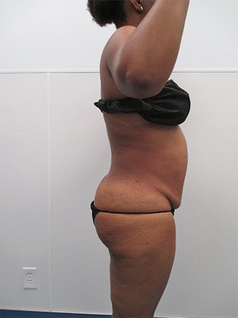 Liposuction Before & After Gallery - Patient 357076 - Image 6