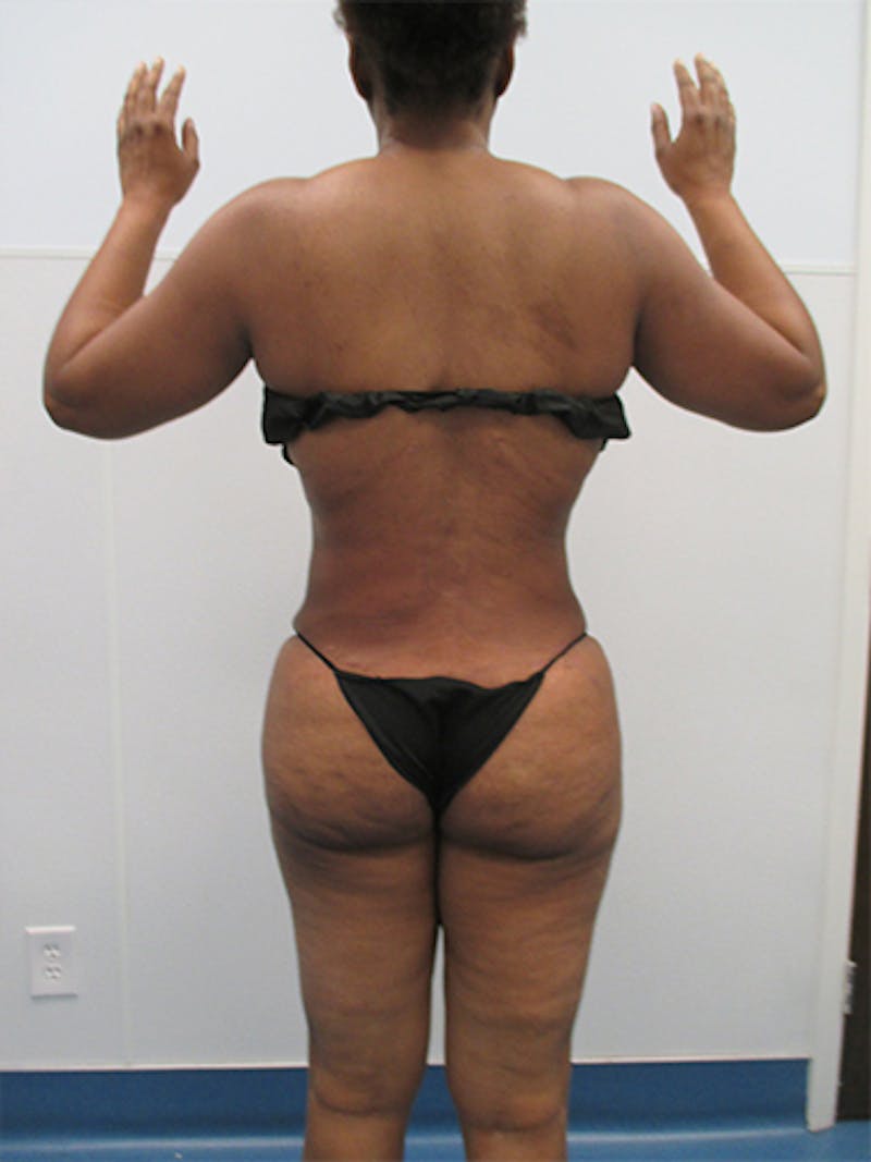 Liposuction Before & After Gallery - Patient 357076 - Image 10