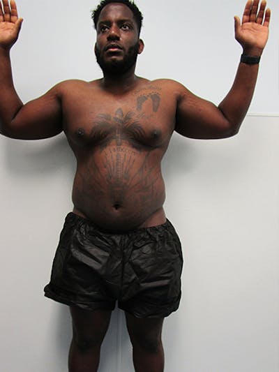 Liposuction Before & After Gallery - Patient 379664 - Image 1