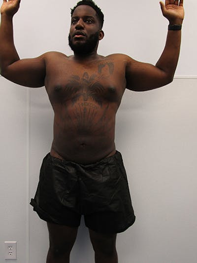Liposuction Before & After Gallery - Patient 379664 - Image 2