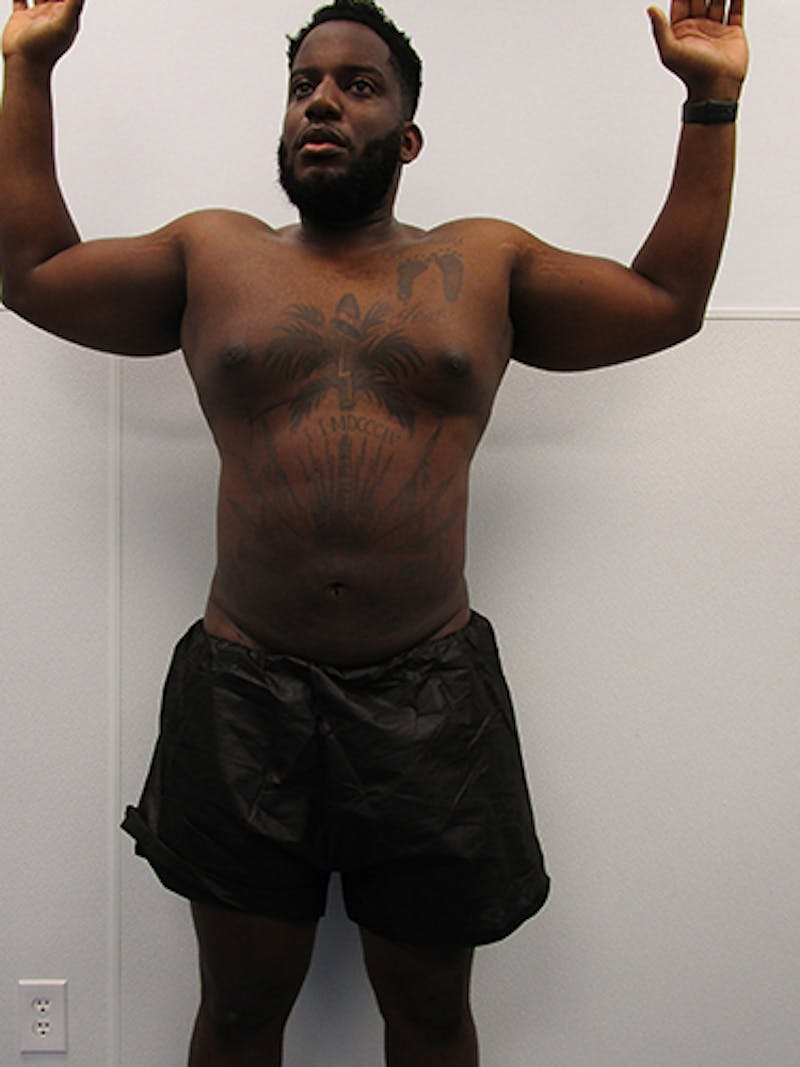 Liposuction Before & After Gallery - Patient 379664 - Image 2