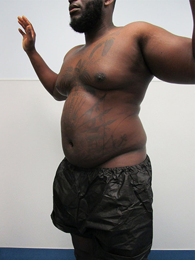 Liposuction Before & After Gallery - Patient 379664 - Image 3