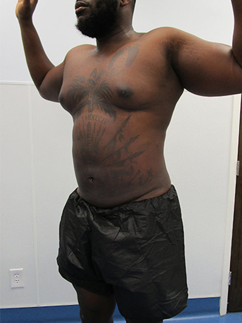 Liposuction Before & After Gallery - Patient 379664 - Image 4