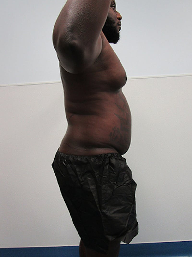 Liposuction Before & After Gallery - Patient 379664 - Image 5