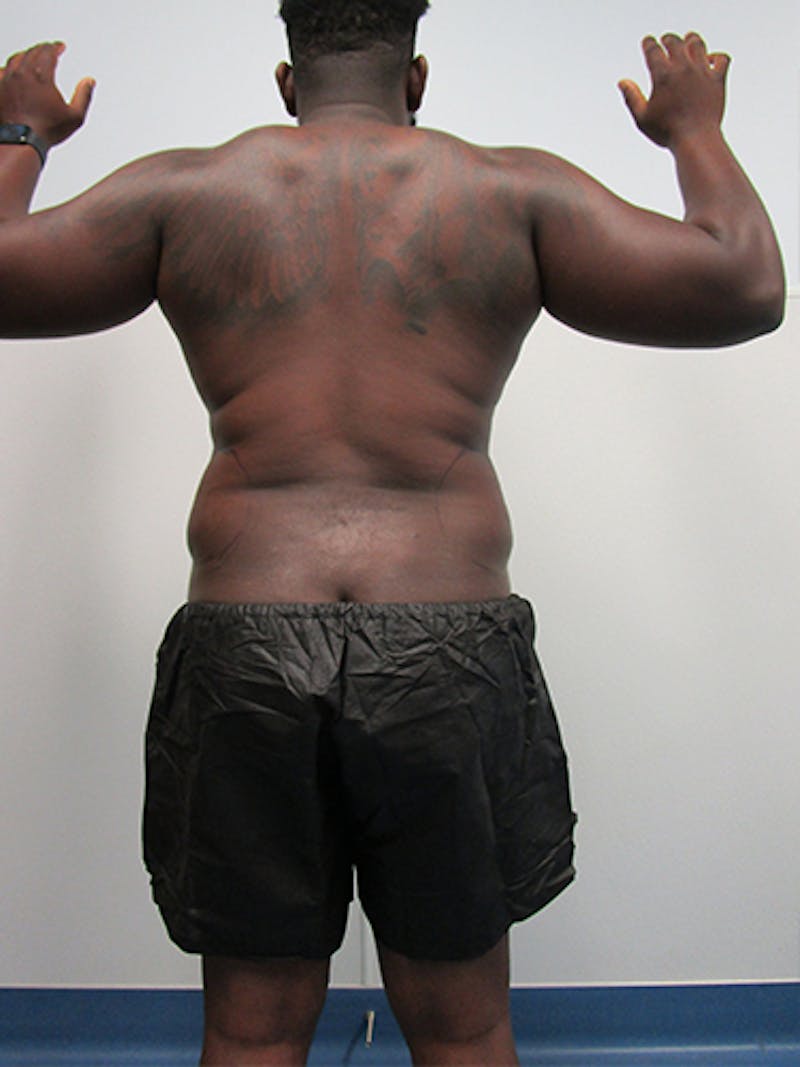 Liposuction Before & After Gallery - Patient 379664 - Image 7